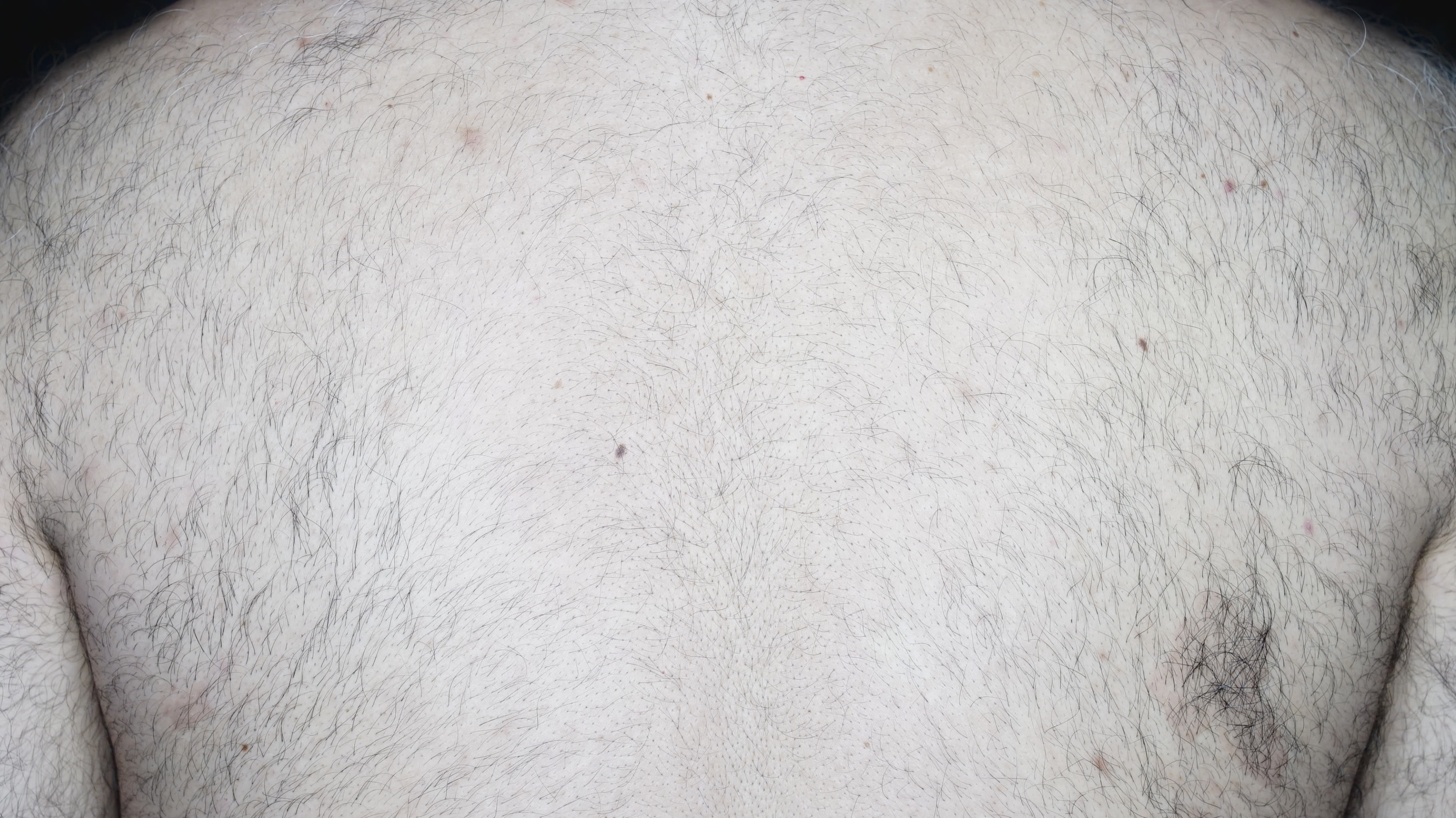Laser hair removal back after one session